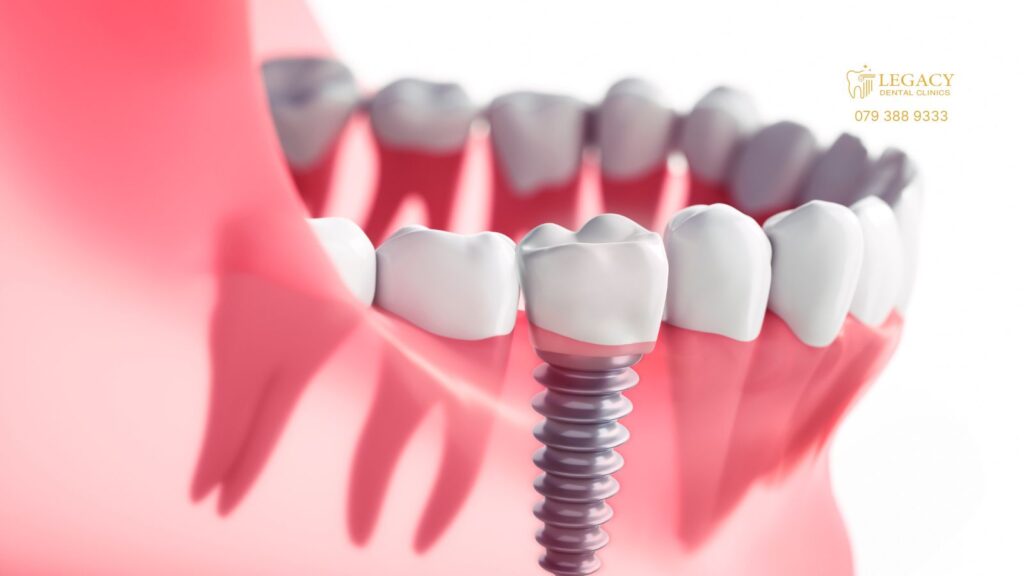 أسعار زراعة الأسنان في الأردن