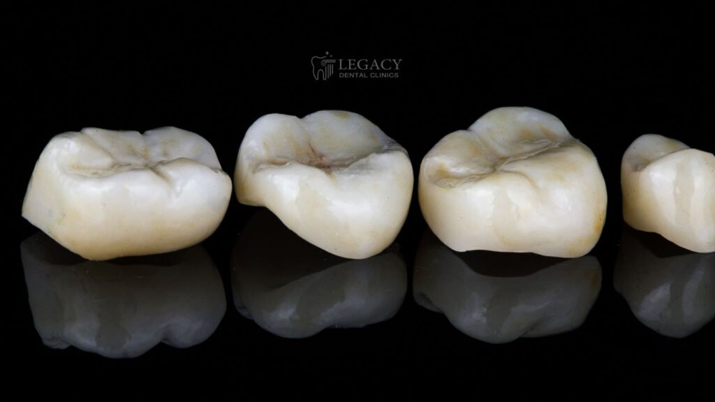 كم سنة تدوم أسنان الزيركون؟