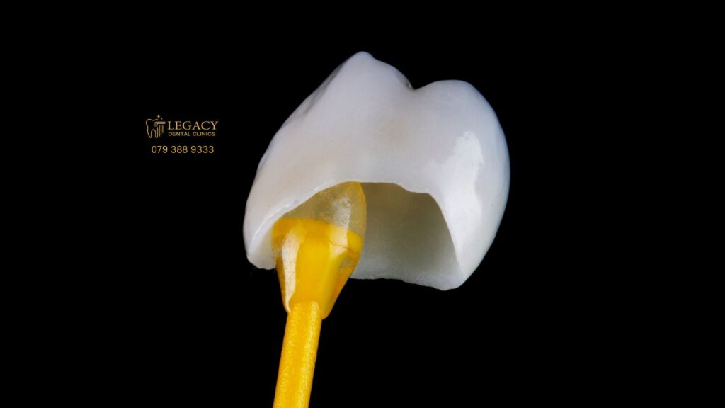 هل يجب سحب العصب قبل تركيب الزيركون؟