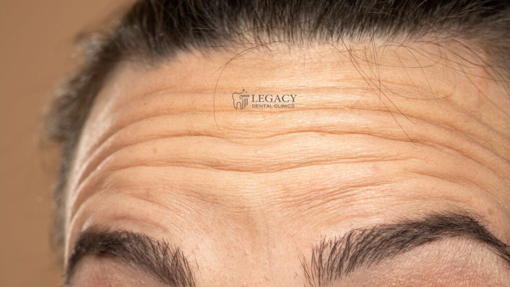 كم إبرة بوتكس يحتاج الوجه؟