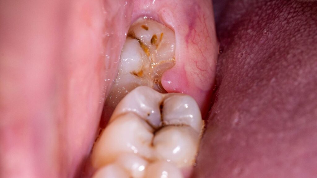 كم تكلفة خلع ضرس العقل في الأردن؟