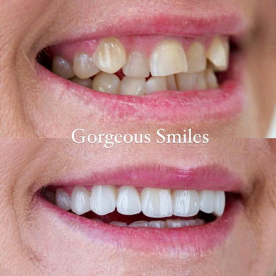 تقويم انفزلاين قبل وبعد في الأردن