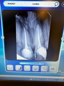 Root Canal Treatment Amman Jordan