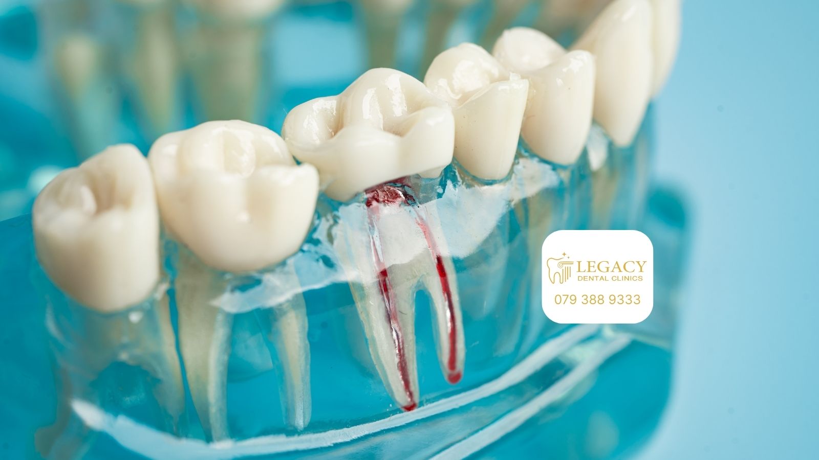 Root Canal Treatment in Amman