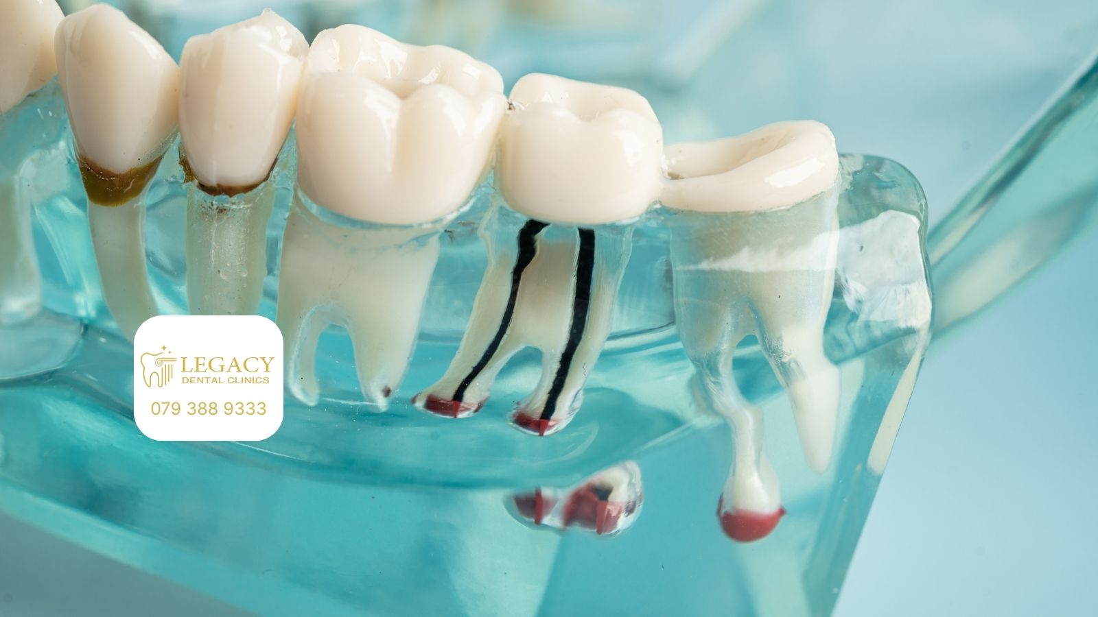 endodontic treatment amman