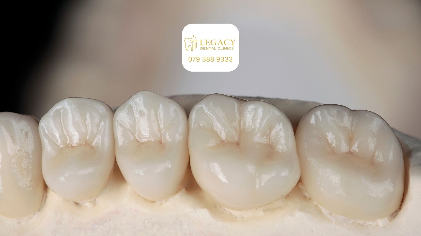 dental crown bridge amman jordan