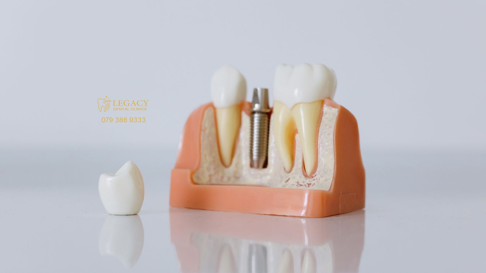 Why a Dental Implant is the Best Replacement of Natural Teeth?​