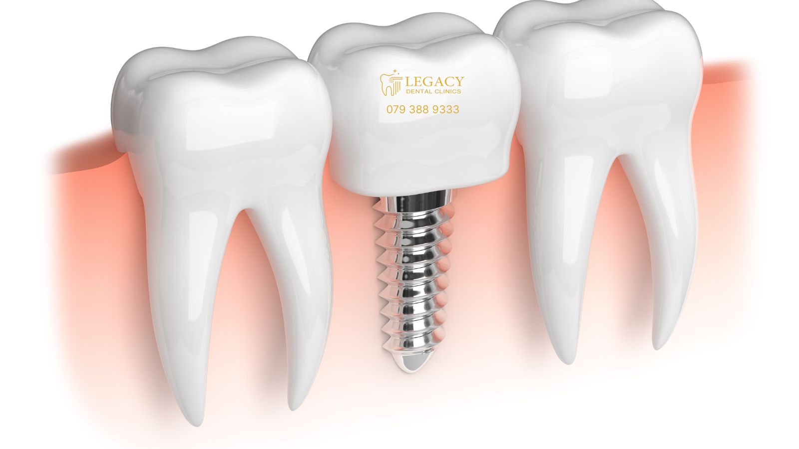 Why Choose Legacy Dental Clinics in Amman for Your Dental Implants?​
