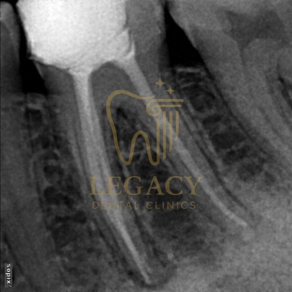 Root Canal Treatment for a Pregnant Lady