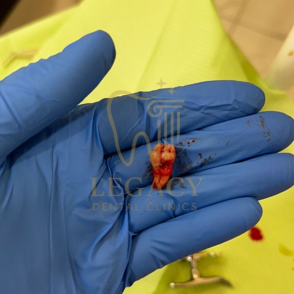 Extraction of Lower Wisdom Tooth
