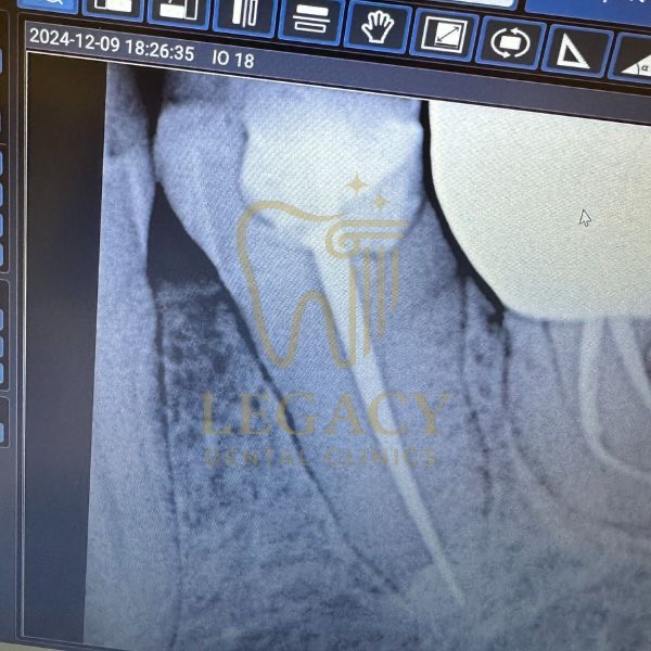 Single Visit Root Canal Treatment