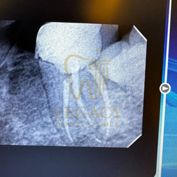 Root Canal Treatment Lower Molar