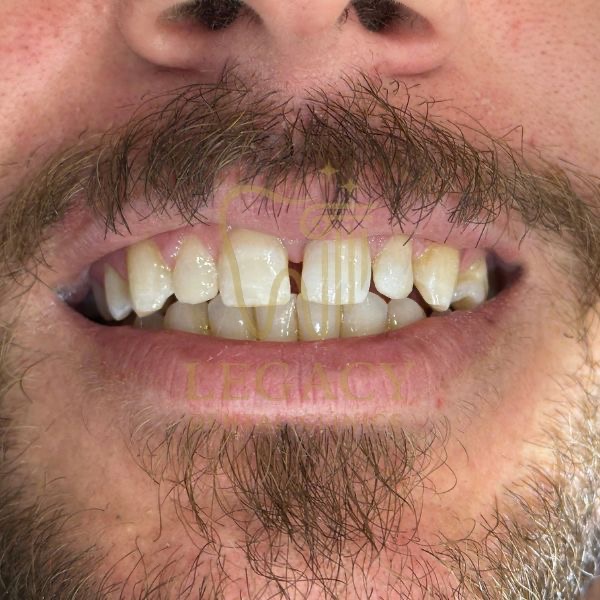 Correction of Peg Shaped Lateral Incisors with Composite Build up