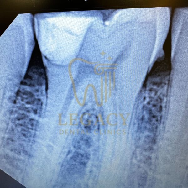 Deep Composite Restoration