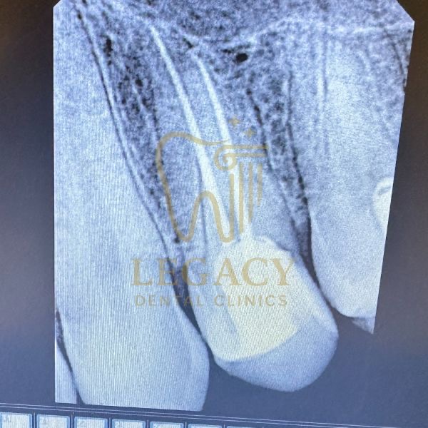 Single Visit Root Canal Treatment