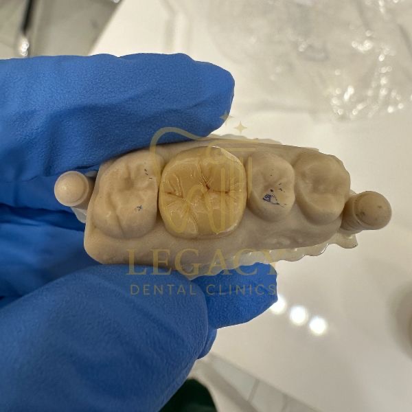 Zirconia Dental Crown