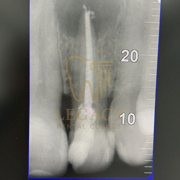 Root Canal Retreatment Upper Anterior Tooth