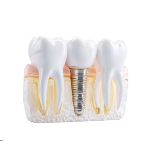 Dental implant amman jordan