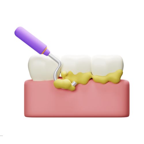 dental scaling & polishing