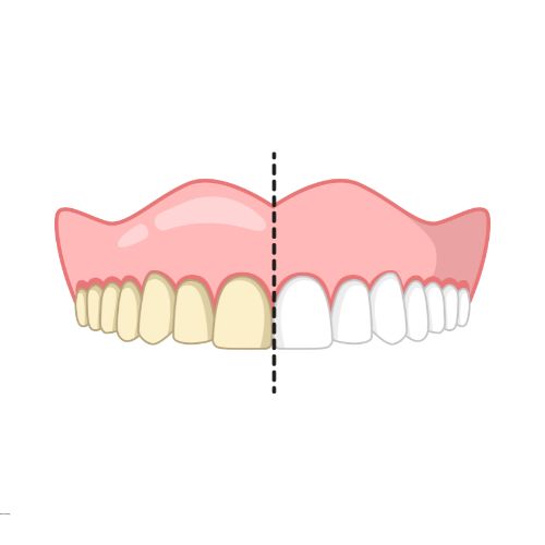 laser teeth whitening amman, laser teeth whitening near me