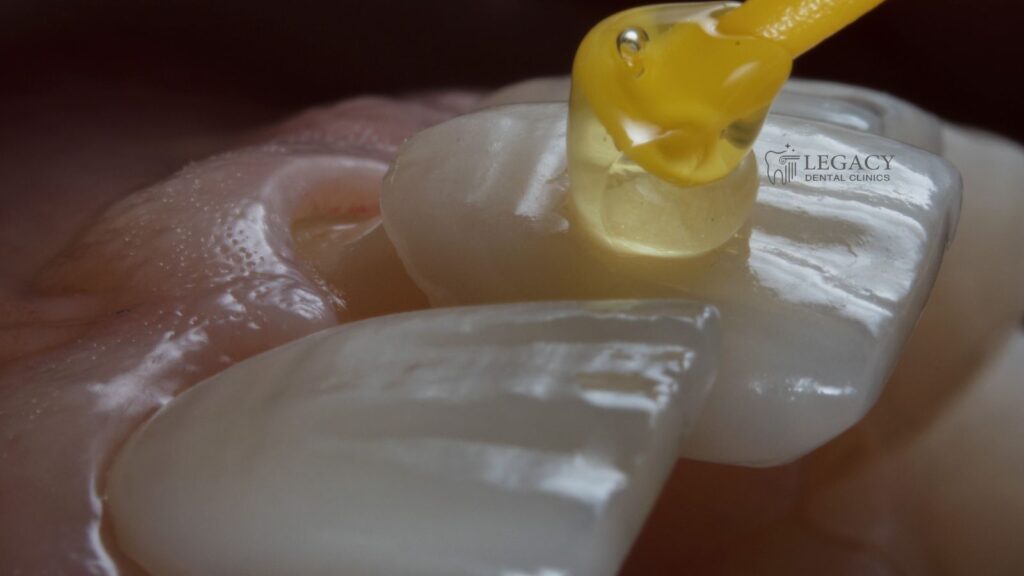 How much do veneers cost in Amman, Jordan?