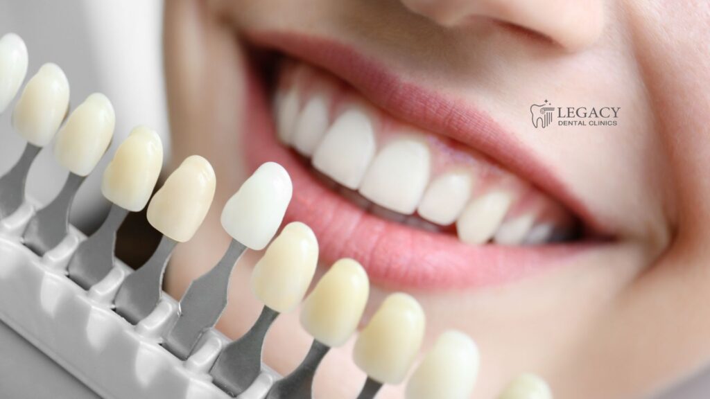 How much does teeth whitening cost in Amman?