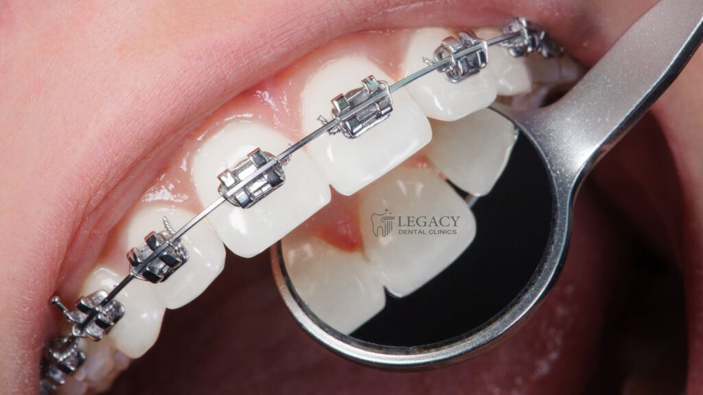 How long do braces take and what to Expect?