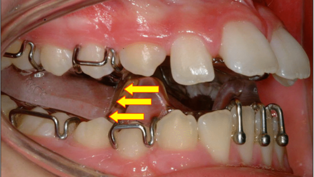 What age is best best for twin block treatment?