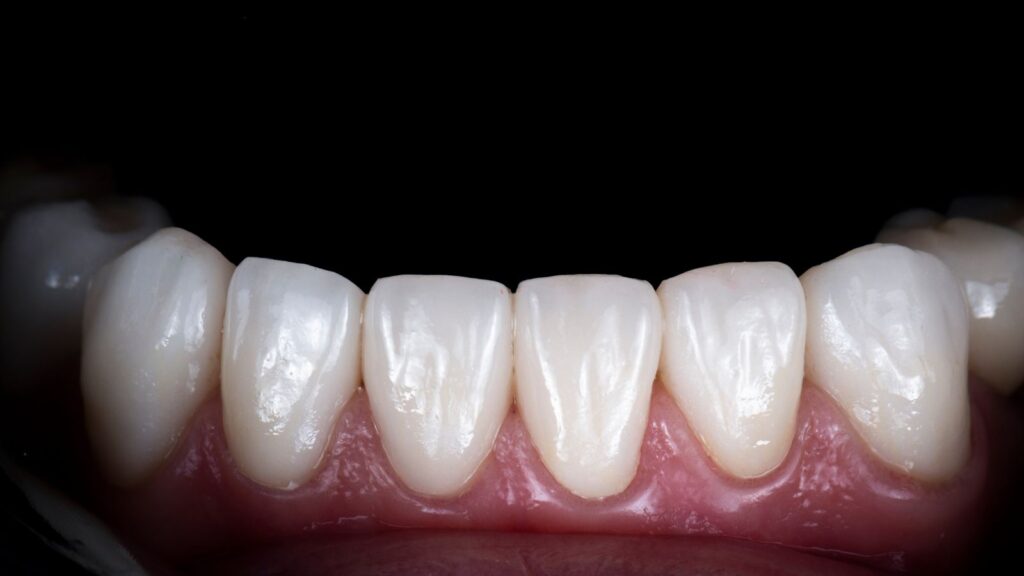Best 10 Emax Veneers Clinics in Amman