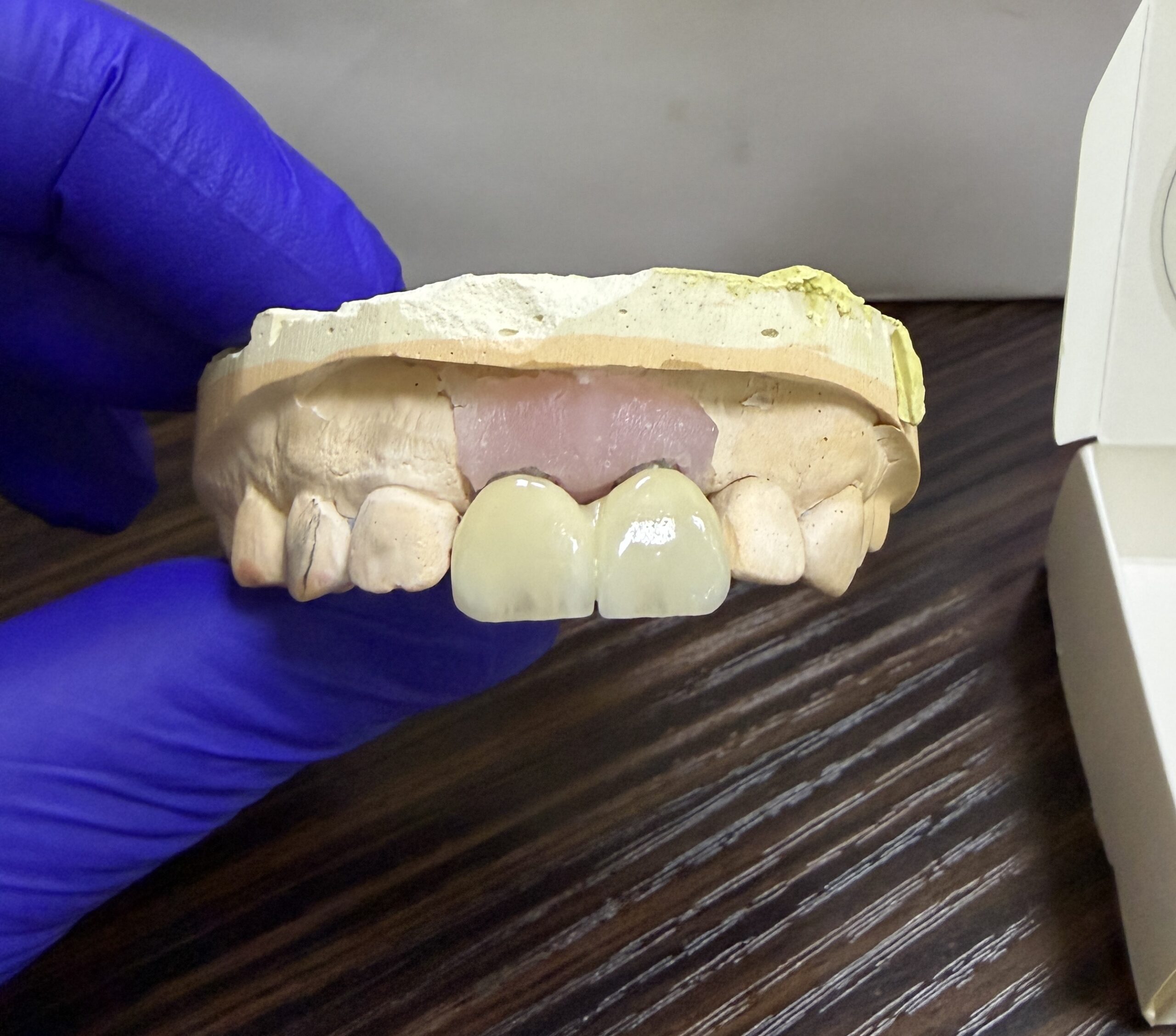 Zirconia Bridge on Two Implants