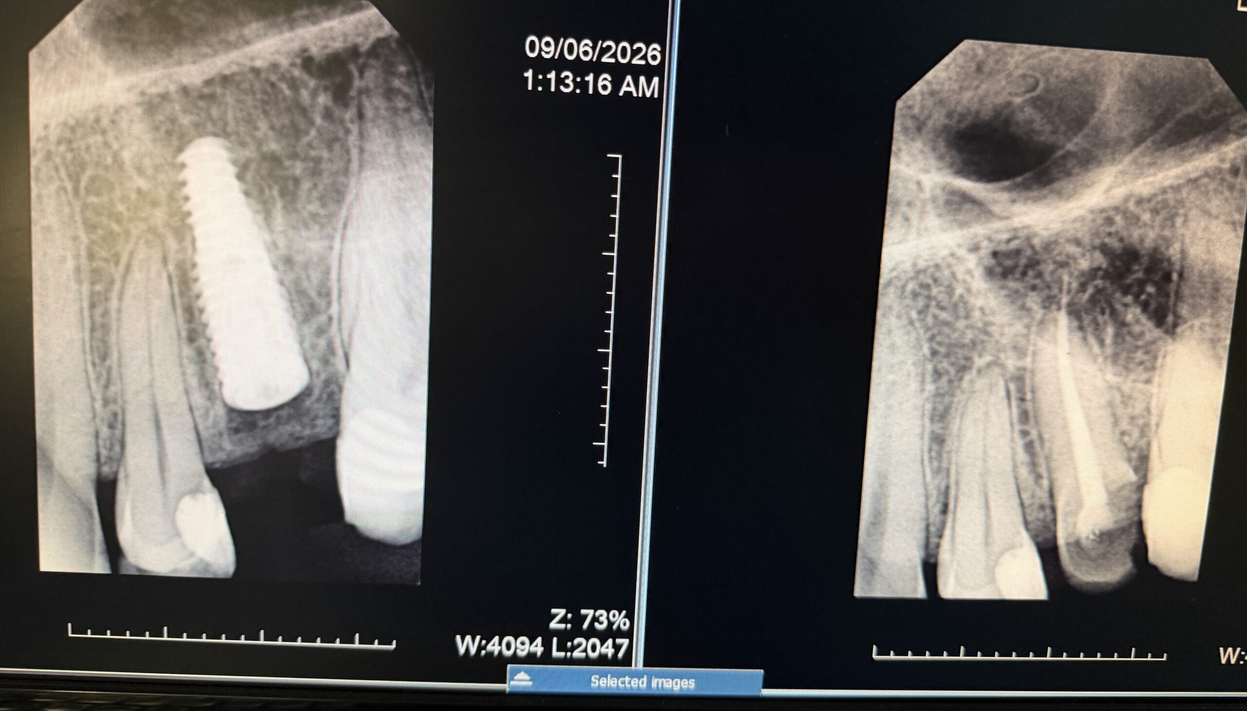 Immediate implants amman