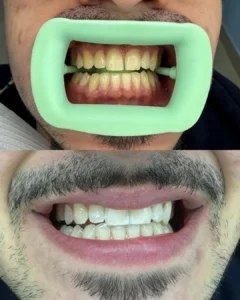 laser teeth whitening case 2 - Legacy dental clinics