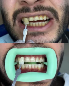 laser teeth whitening case - legacy dental clinics