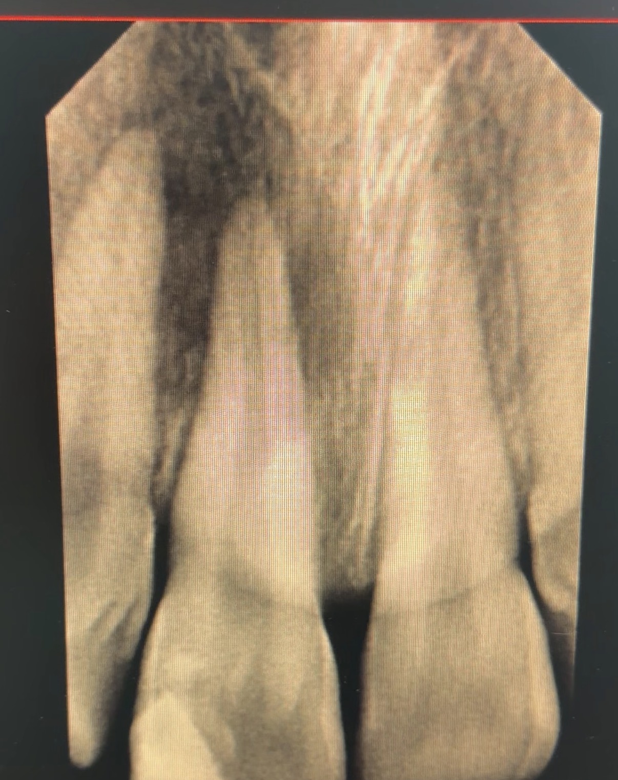 Acute Apical Abcess Case: 12 Years Old Girl